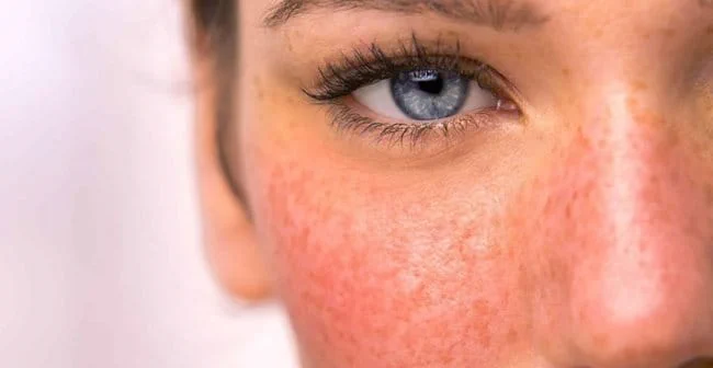 Phương pháp chăm sóc da cho người bị rosacea hiệu quả tại nhà